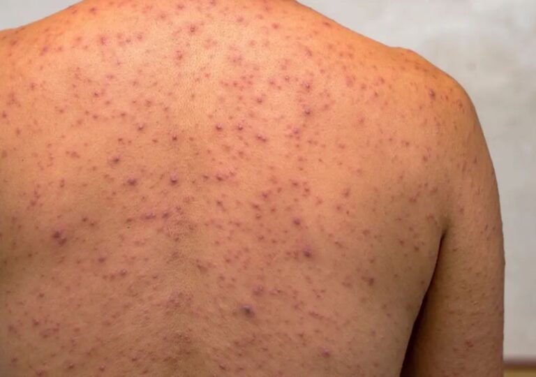 Profissional de saúde analisando material laboratorial de vírus mpox em laboratório