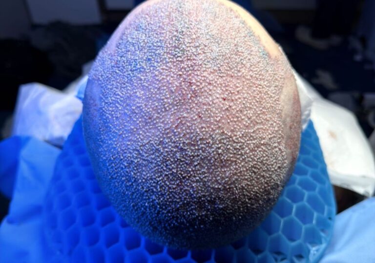 Procedimento de transplante capilar com alto número de enxertos realizado no Brasil