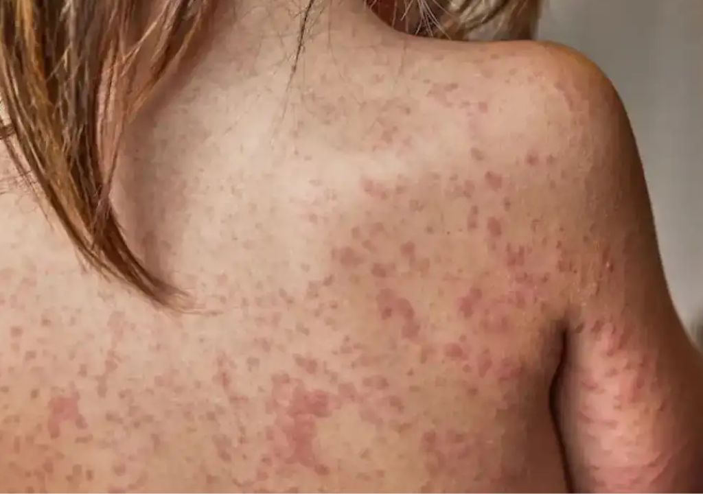 Pessoa com sintomas de sarampo durante alerta de vigilância da doença no Brasil